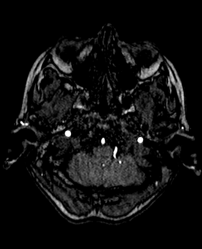 Berry aneurysm of the terminal internal carotid artery (Radiopaedia 88286-104918 Axial TOF 55).jpg