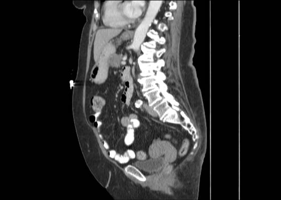 Bicameral celiacomesenteric aneurysm (Radiopaedia 55766-62327 B 33).jpg