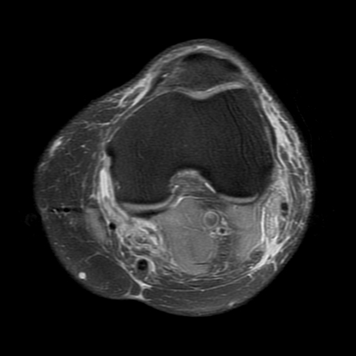 File:Biceps femoris distal tendon avulsion (Radiopaedia 15109-14987 Axial PD fat sat 10).jpg