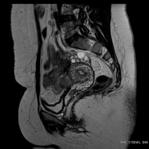 File:Bicornuate uterus- on MRI (Radiopaedia 49206-54297 Sagittal T2 10).jpg