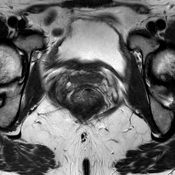 File:Bicornuate uterus (Radiopaedia 61974-70046 Axial T2 23).jpg