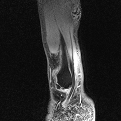 Bilateral Achilles tendon complete tear (Radiopaedia 81344-95051 Sagittal WE - Right 19).jpg