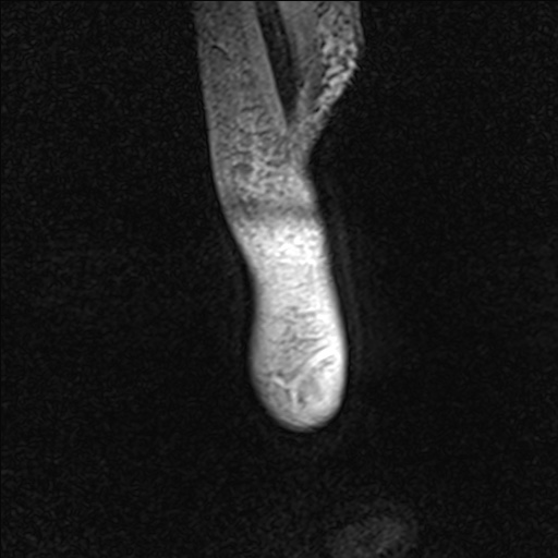 Bilateral Achilles tendon complete tear (Radiopaedia 81344-95051 Sagittal WE - Right 8).jpg