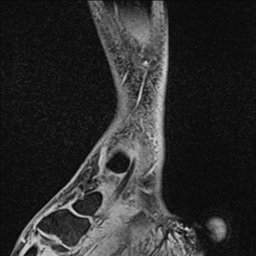Bilateral Achilles tendon complete tear (Radiopaedia 81344-95051 Sagittal WE - Right 88).jpg