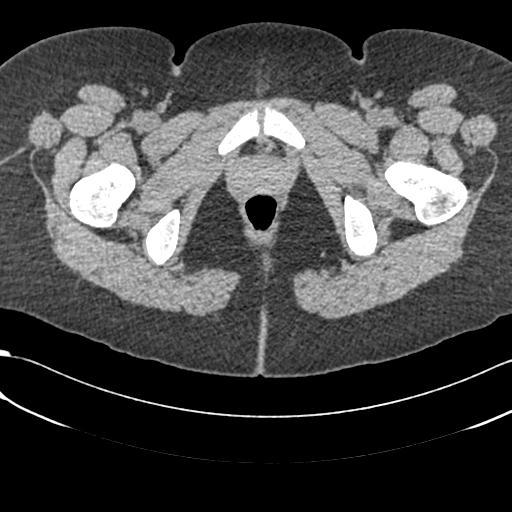 File:Bilateral acetabular protrusion with pincer type femoro-acetabular impingement (Radiopaedia 30134-30733 AXIAL SOFT THIN 78).jpg