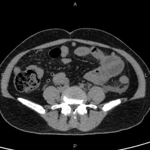Bilateral adrenal gland hyperenhancement in pancreatitis (Radiopaedia 86642-102753 Axial non-contrast 75).jpg