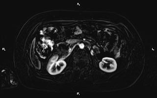Bilateral adrenal myelolipoma (Radiopaedia 63058-71537 I 49).jpg