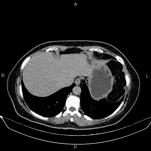 Bilateral benign adrenal adenomas (Radiopaedia 86912-103124 Axial C+ delayed 2).jpg