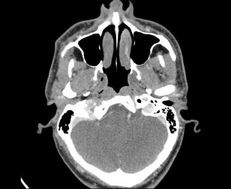 Bilateral carotid body tumors (Radiopaedia 61841-69870 Axial Post contrast 6).jpg