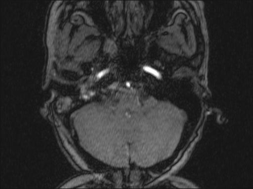 Bilateral carotid body tumors and right glomus jugulare tumor (Radiopaedia 20024-20060 Axial MRA 313).jpg