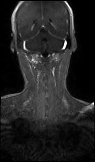 Bilateral carotid body tumors and right glomus jugulare tumor (Radiopaedia 20024-20060 MRA 59).jpg