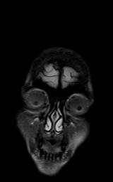 File:Bilateral carotid body tumors and right jugular paraganglioma (Radiopaedia 20024-20060 Coronal 80).jpg