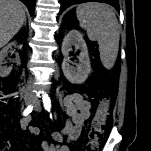 File:Bilateral delayed nephrogram from renal artery stenosis (Radiopaedia 47681-52362 B 15).png