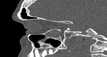 File:Bilateral ectopic infraorbital nerves (Radiopaedia 49006-54084 Sagittal 13).png