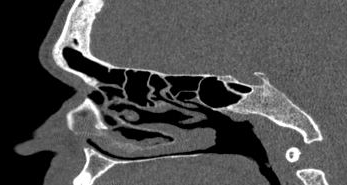 File:Bilateral ectopic infraorbital nerves (Radiopaedia 49006-54084 Sagittal 3).png
