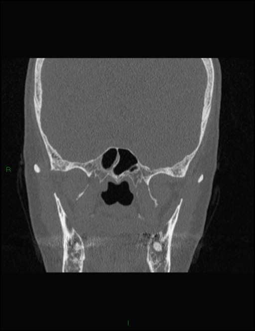 Bilateral frontal mucoceles (Radiopaedia 82352-96454 Coronal 231).jpg