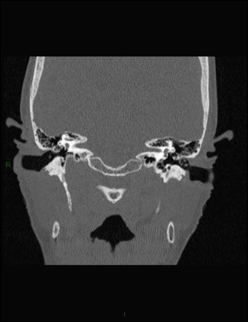 Bilateral frontal mucoceles (Radiopaedia 82352-96454 Coronal 308).jpg