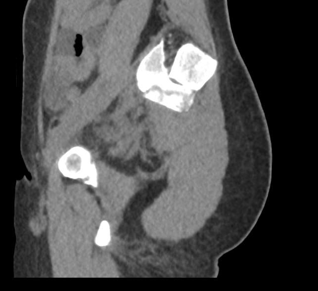 Bilateral mature cystic ovarian teratoma (Radiopaedia 88821-105592 D 57).jpg