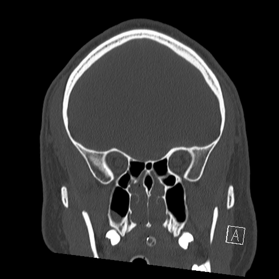 Bilateral occipital condyle fracture (type 2) (Radiopaedia 87675-104089 Coronal bone window 29).jpg