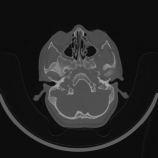 Bilateral otosclerosis (Radiopaedia 57237-64157 C 26).jpg