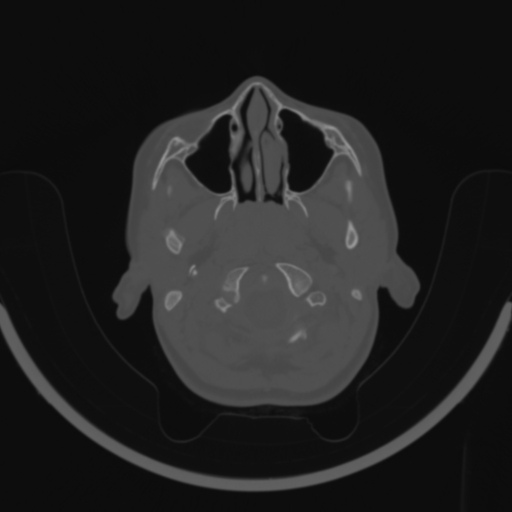 Bilateral otosclerosis (Radiopaedia 57237-64157 C 3).jpg