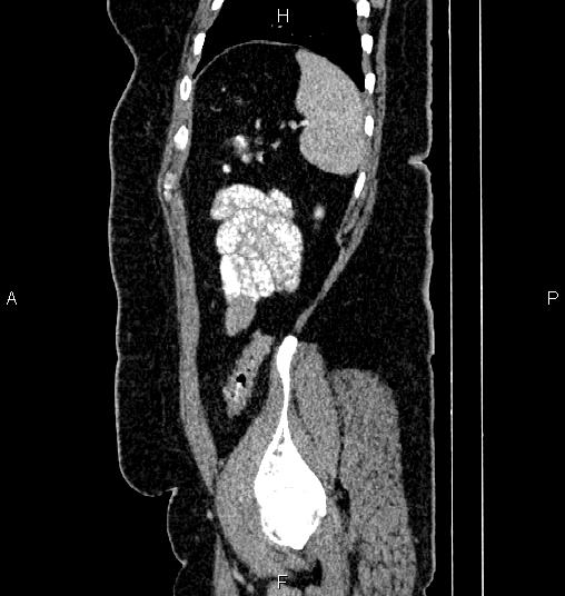 Bilateral ovarian dermoid cysts (Radiopaedia 85785-101603 D 80).jpg