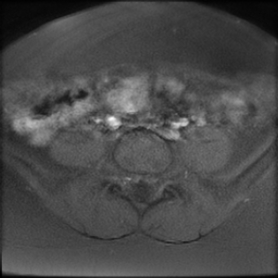 File:Bilateral ovarian fibrothecomas - adolescent (Radiopaedia 86604-102707 Axial T1 fat sat 3).jpg