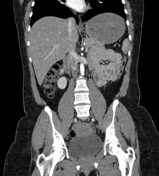 File:Bilateral ovarian mature cystic teratomas (Radiopaedia 79373-92457 B 36).jpg