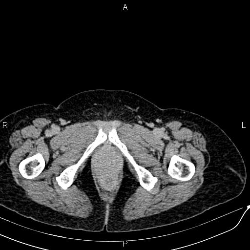 Bilateral ovarian serous cystadenocarcinoma (Radiopaedia 86062-101989 Axial C+ delayed 88).jpg