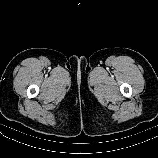 File:Bilateral ovarian teratoma (Radiopaedia 83131-97503 Axial With contrast 104).jpg