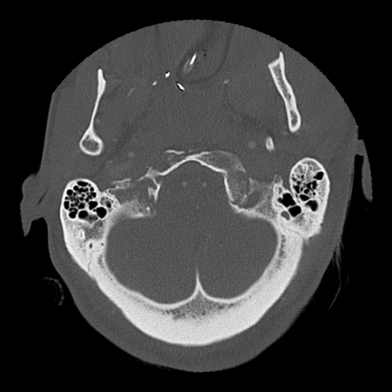 File:Bilateral perched facets with cord injury (Radiopaedia 45587-49713 Axial bone window 18).jpg