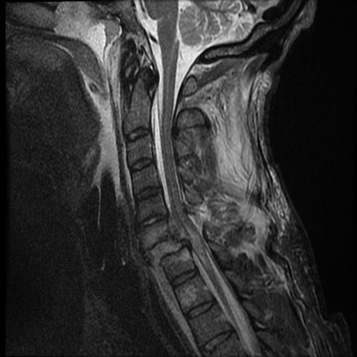 File:Bilateral perched facets with cord injury (Radiopaedia 45587-49714 Sagittal STIR 8).jpg