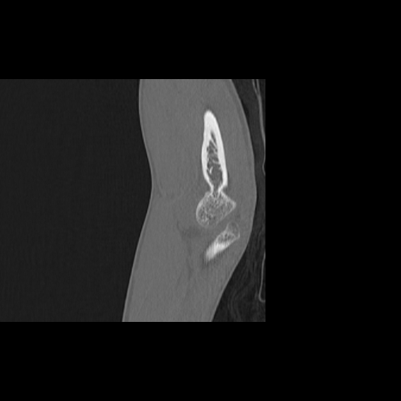 File:Bilateral proximal radioulnar synostosis (Radiopaedia 66532-75812 B 12).jpg
