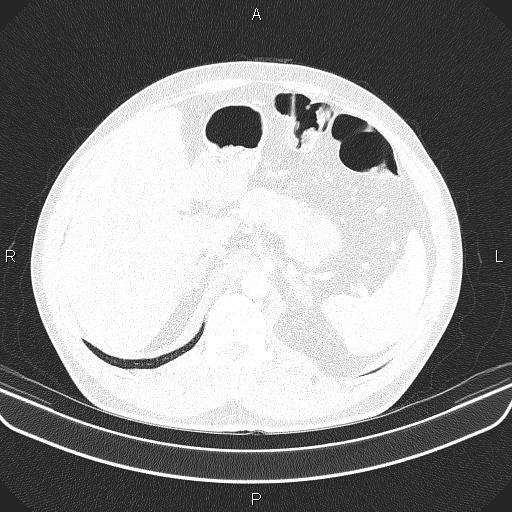 File:Bilateral pulmonary AVM (Radiopaedia 83134-97505 Axial lung window 75).jpg