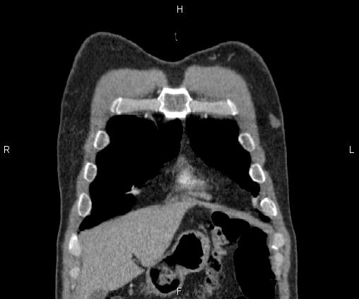 Bilateral pulmonary AVM (Radiopaedia 83134-97505 C 13).jpg