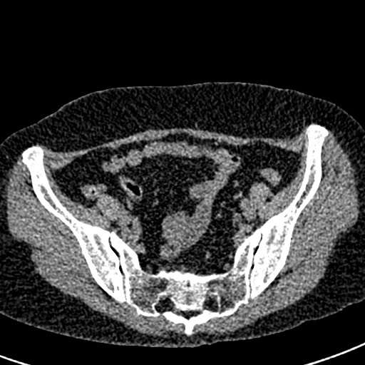 Bilateral staghorn calculi (Radiopaedia 59475-66842 Axial non-contrast 63).jpg