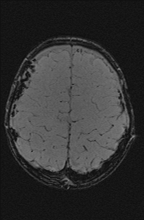 File:Bilateral subdural hemorrhage and parietal skull fracture (Radiopaedia 26058-26190 Axial SWI 63).png