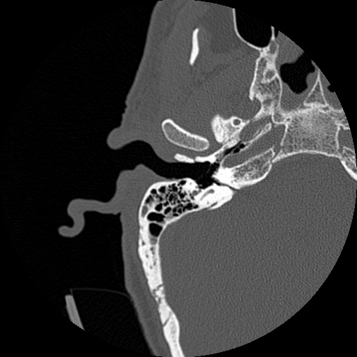 File:Bilateral temporal bone fractures (Radiopaedia 29482-29970 Axial non-contrast 4).jpg