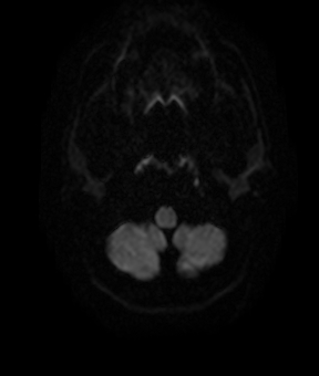 File:Bilateral thalamic gliomata (Radiopaedia 42538-45664 Axial DWI 3).jpg