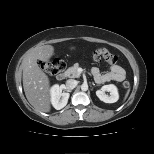 File:Billroth I gastric resection (Radiopaedia 17685-17425 None 8).jpg
