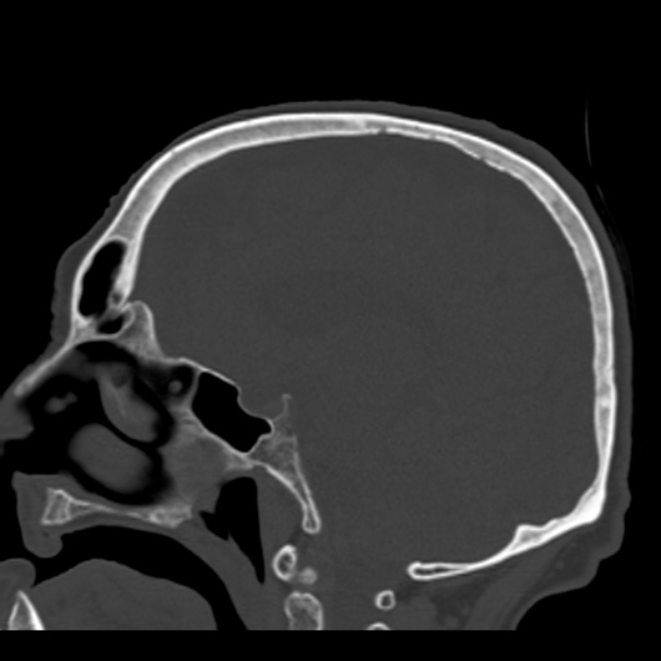 Biparietal osteodystrophy (Radiopaedia 46109-50463 Sagittal bone window 58).jpg
