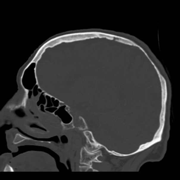 Biparietal osteodystrophy (Radiopaedia 46109-50463 Sagittal bone window 65).jpg