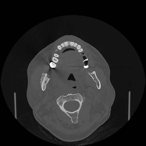 File:Bisphosphonate-related osteonecrosis of the jaw (Radiopaedia 71324-81642 Axial bone window 88).jpg