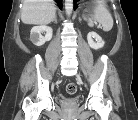 File:Bladder papillary urothelial carcinoma (Radiopaedia 48119-52951 C 44).png