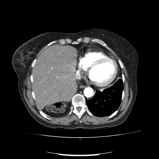 File:Bladder tumor detected on trauma CT (Radiopaedia 51809-57609 A 69).jpg