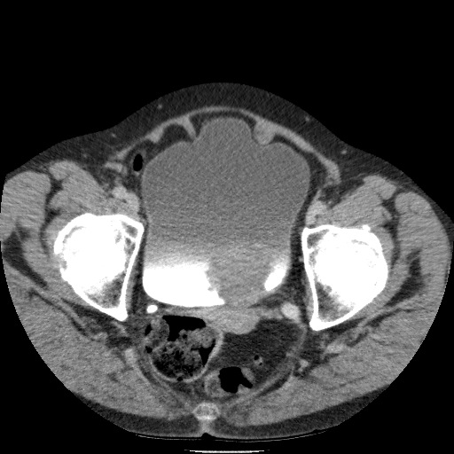 Bladder tumor detected on trauma CT (Radiopaedia 51809-57609 C 127).jpg
