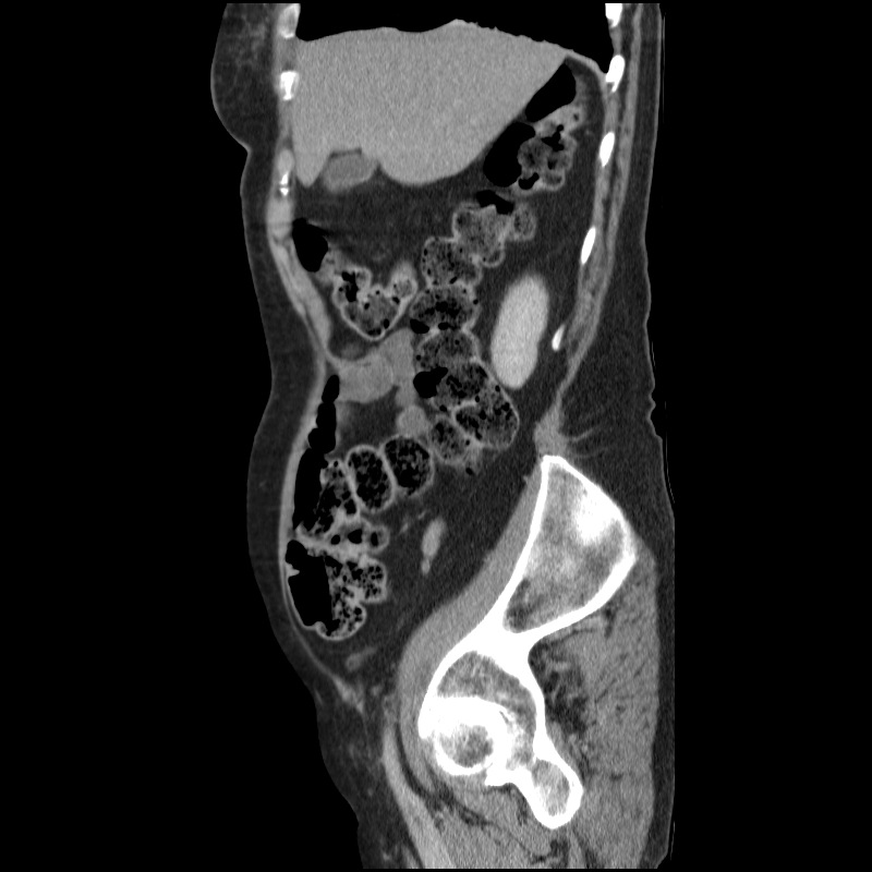 Bladder tumor detected on trauma CT (Radiopaedia 51809-57609 E 57).jpg