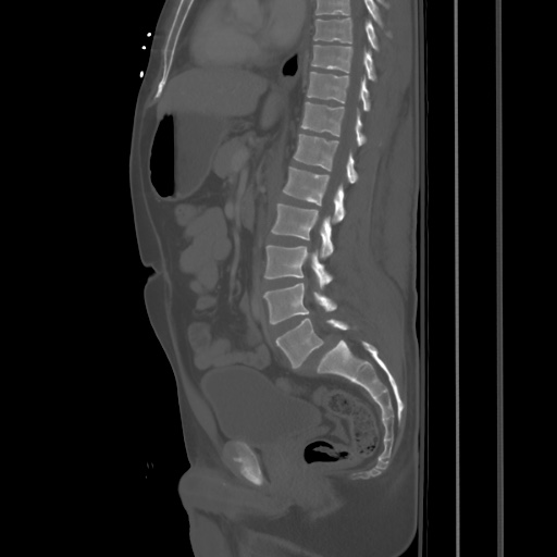 Blunt abdominal trauma with solid organ and musculoskelatal injury with active extravasation (Radiopaedia 68364-77895 Sagittal bone window 50).jpg