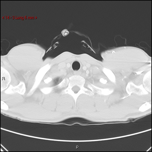 File:Blunt chest trauma - pulmonary interstitial emphysema and pneumomediastinum (Radiopaedia 20666-20552 Axial lung window 3).jpg