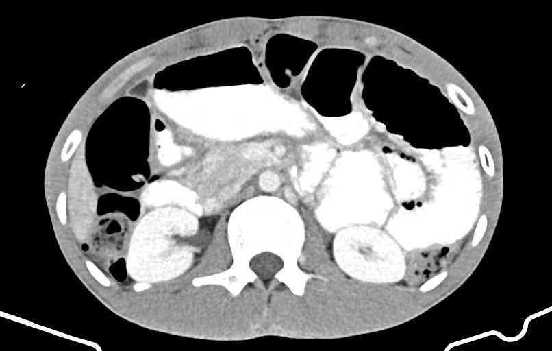Blunt injury to the small bowel (Radiopaedia 74953-85987 A 60).jpg